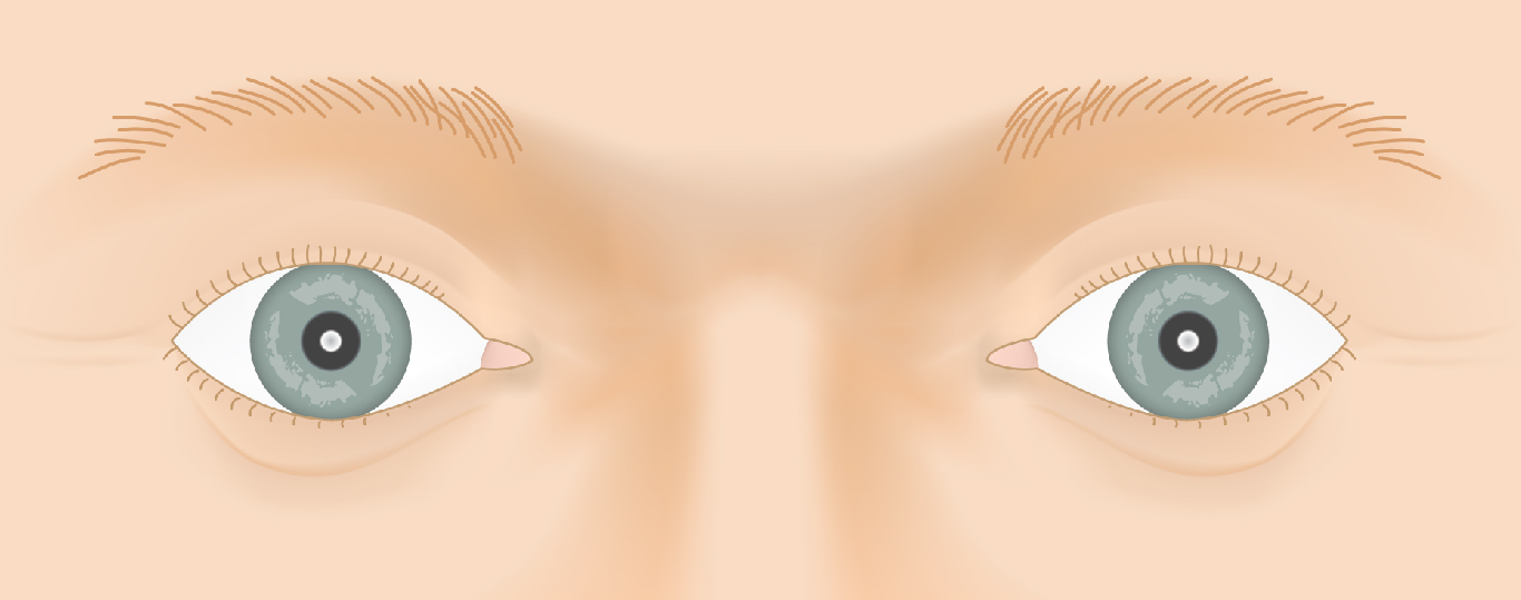 Thyroid Eye Disease — Disease Progression — slide 1 of 6
