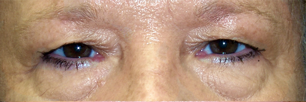 Before Upper and Lower Blepharoplasty — case 35829