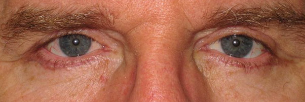 Before Upper and Lower Blepharoplasty — case 71120