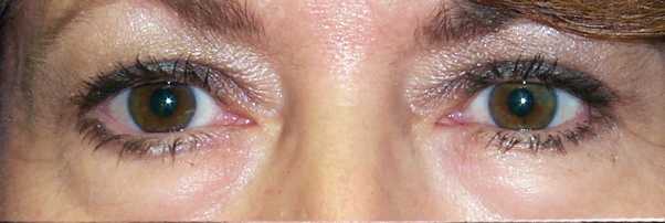 Before Upper and Lower Blepharoplasty — case 73603