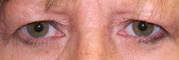 Before Upper Blepharoplasty — case 31700