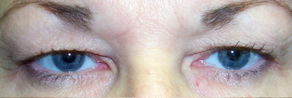 Before Upper Blepharoplasty — case 33031