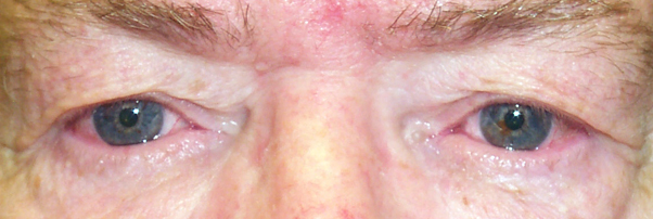 Before Upper Blepharoplasty — case 57139