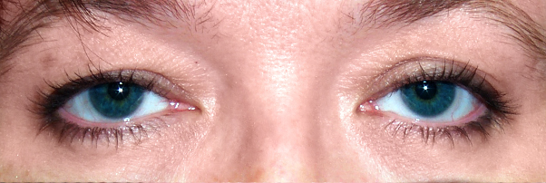 Before Ptosis and Upper Blepharoplasty — case 3689