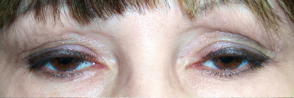 Before Ptosis and Upper Blepharoplasty — case 19775