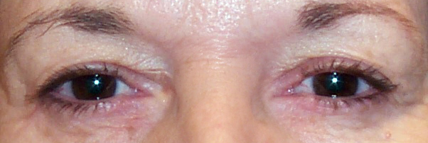 Before Ptosis and Upper Blepharoplasty — case 72355