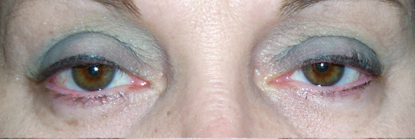 Before Ptosis Surgery — case 34835