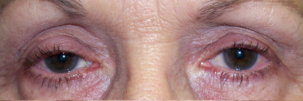 Before Ptosis Surgery — case 57156