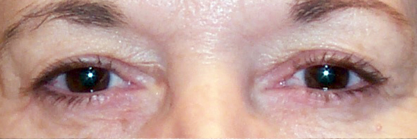 Before Ptosis Surgery — case 72355