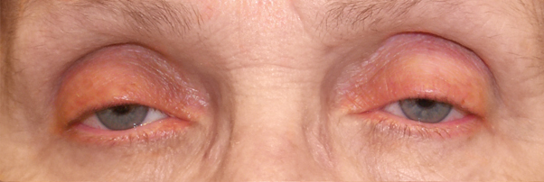 Ptosis — drooping upper eyelid margin partially covering the pupil