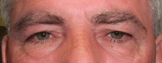 Before Lower Blepharoplasty — case 17a