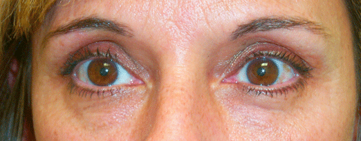 Before Lower Blepharoplasty — case 55b