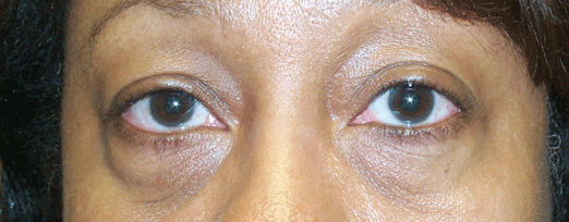 Before Lower Blepharoplasty — case 64b