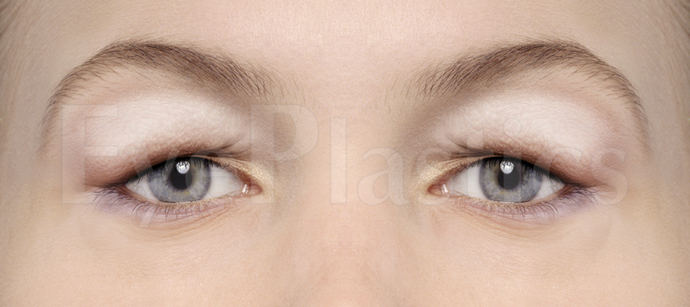 Upper eyelid blepharoplasty before and after