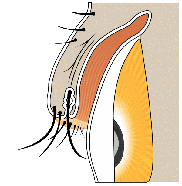 Distichiasis — second row of lashes