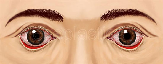 Clinical photograph of ectropion