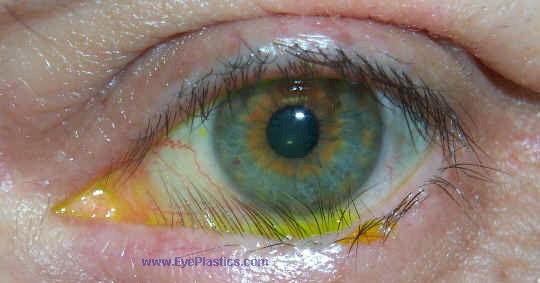 Clinical photograph of trichiasis — eyelashes rubbing on the eye