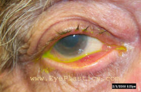 Ectropion showing outward turning of the lower eyelid