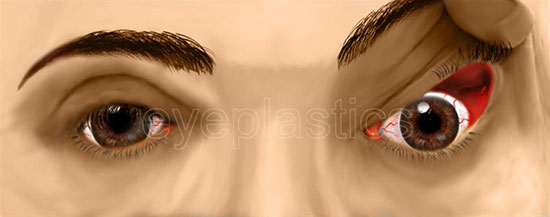 Floppy eyelid syndrome showing easily everted eyelid