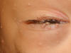Molluscum contagiosum lesions on eyelid