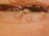 Molluscum contagiosum â€” close-up of eyelid lesions