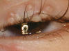 Molluscum contagiosum â€” periocular distribution