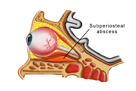 Orbital abscess â€” imaging diagram