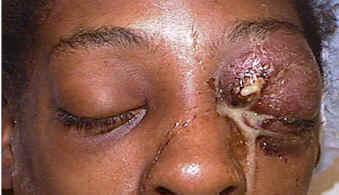 Herpes zoster ophthalmicus affecting the eyelid