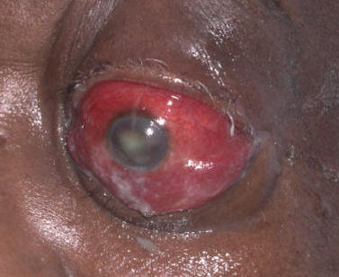 Orbital cellulitis showing periorbital swelling and redness