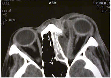 Orbital infection â€” CT imaging