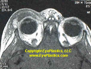 Preseptal periorbital infection