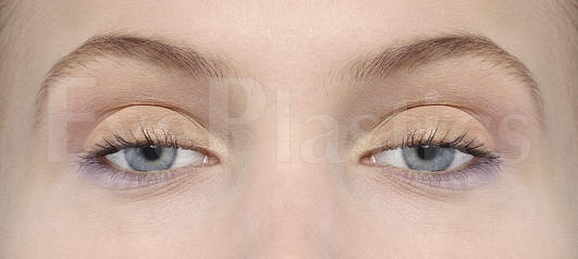 Bilateral ptosis showing drooping of both upper eyelids