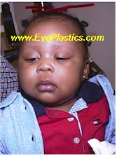 Congenital ptosis pre-operative