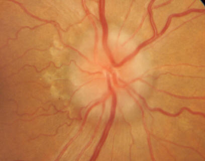 Optic disc edema in severe thyroid eye disease