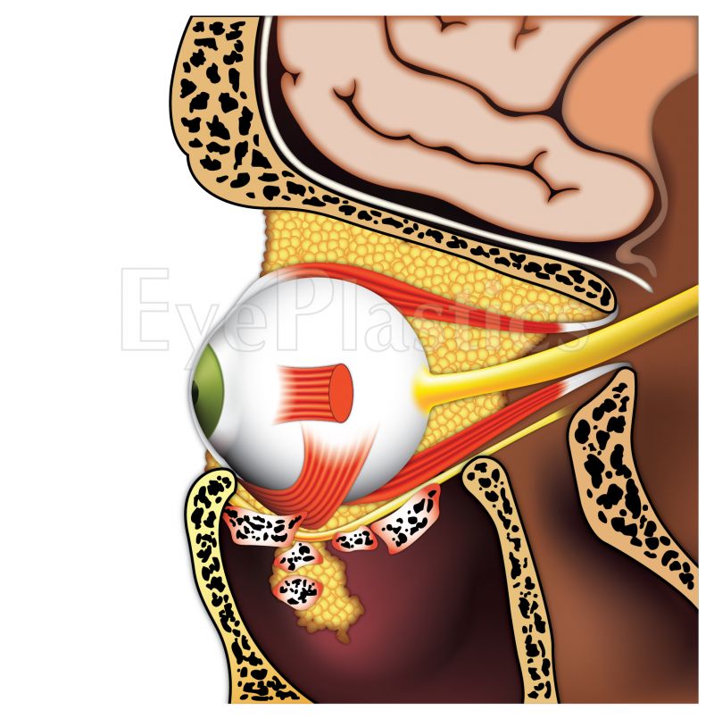 Coronal CT demonstrating orbital floor fracture with herniation of orbital contents into the maxillary sinus